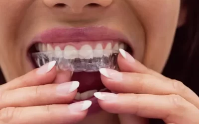 Invisalign San Francisco: Clear Aligner Therapy for Discreet Orthodontic Correction